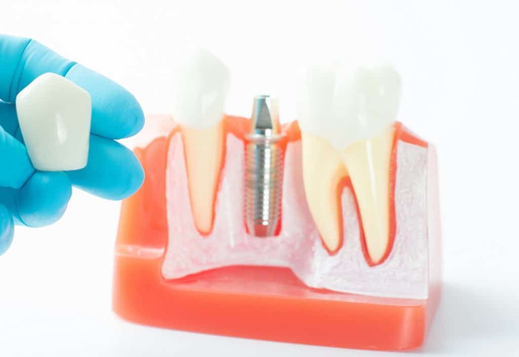 Tooth Loss And The Value Of Dental Implants | Santa Rosa, CA