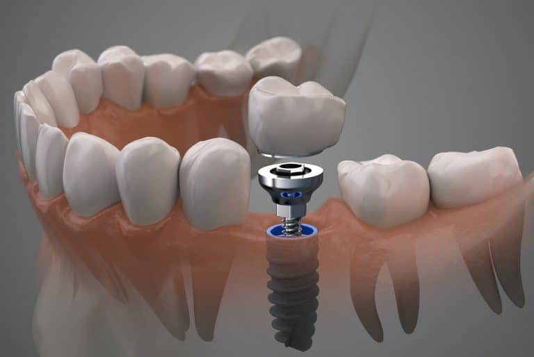 A Brief Look At The Dental Implant Procedure 768x514 