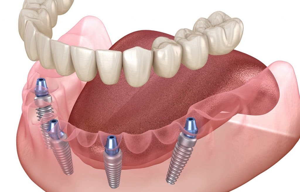Is There a Way to Stop Your Dentures from Slipping? Santa Rosa, CA