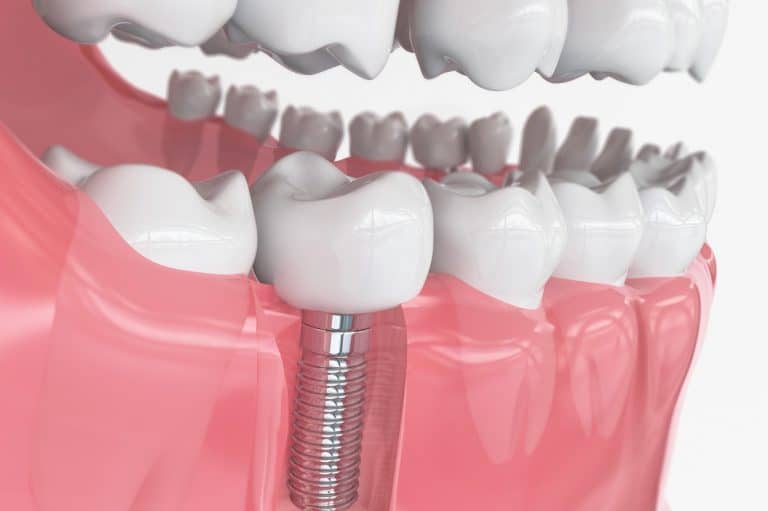 What Makes Dental Implants Santa Rosa, CA