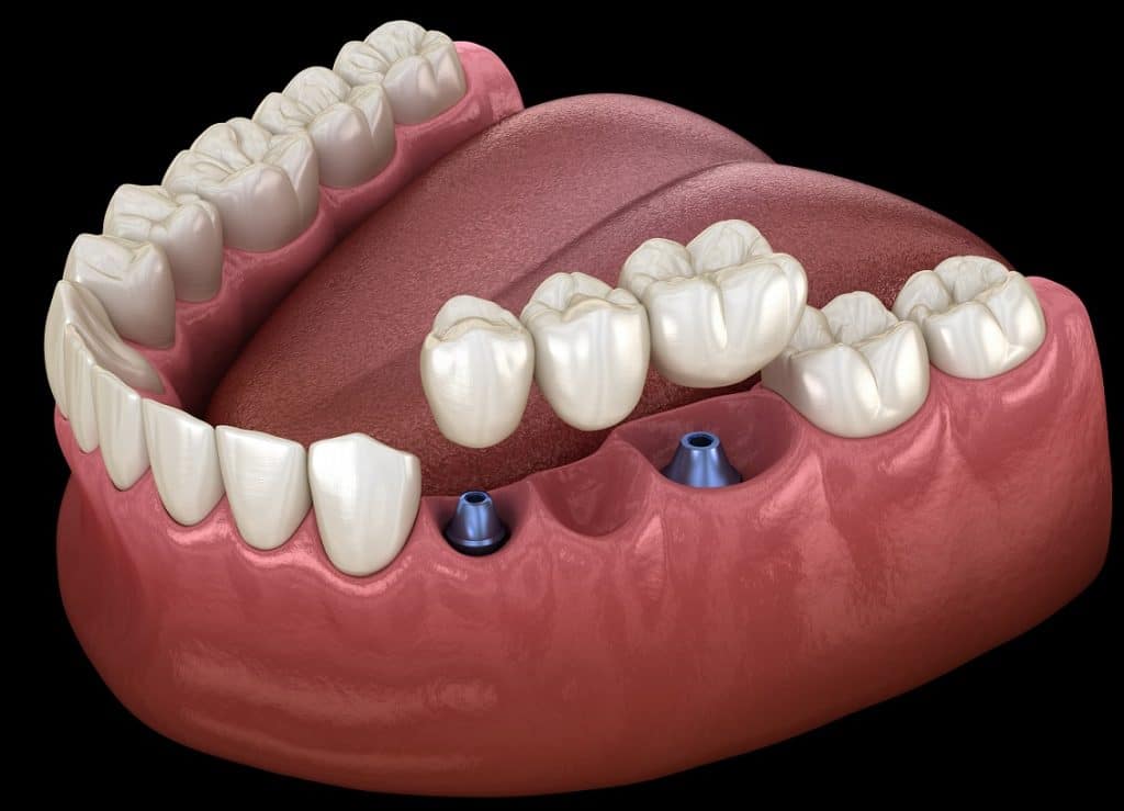 How Bridges and Dentures Perform with Dental Implants | Santa Rosa, CA