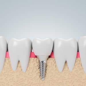 California Implant restoration