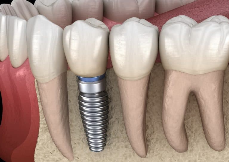 why-the-roots-of-your-teeth-matter-santa-rosa-ca