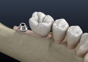 santa rosa jawbone grafting