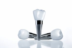 santa rosa dental implants