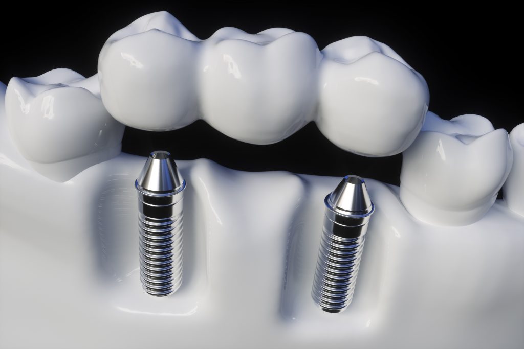 Bridges Last Longer With Dental Implants | Santa Rosa, CA