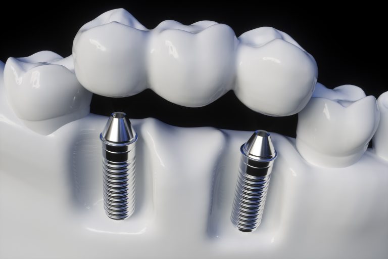 Bridges Last Longer With Dental Implants Santa Rosa, CA