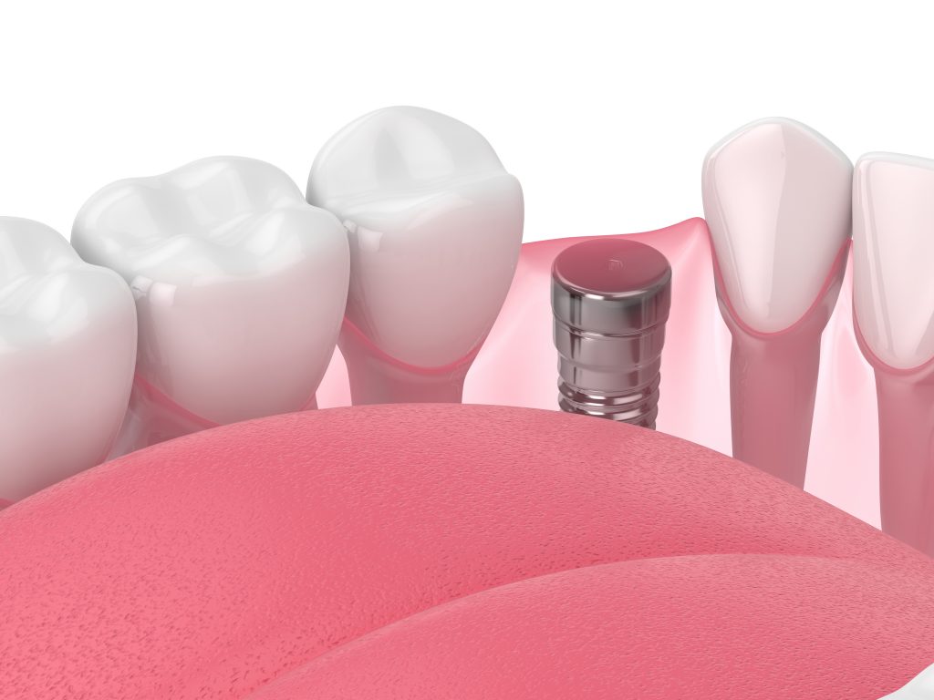 Comfortable Dental Implant Placement Santa Rosa, CA