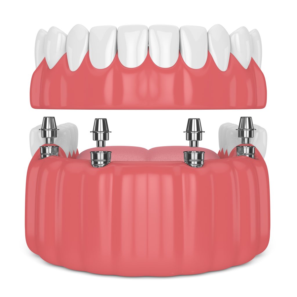 do-implant-dentures-last-longer-santa-rosa-ca