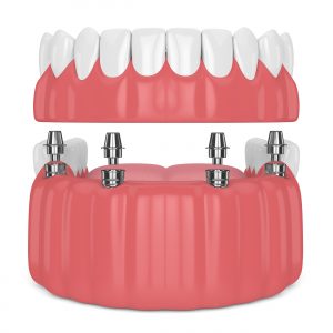 santa rosa dentures implants