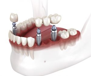 santa rosa extraction and implants