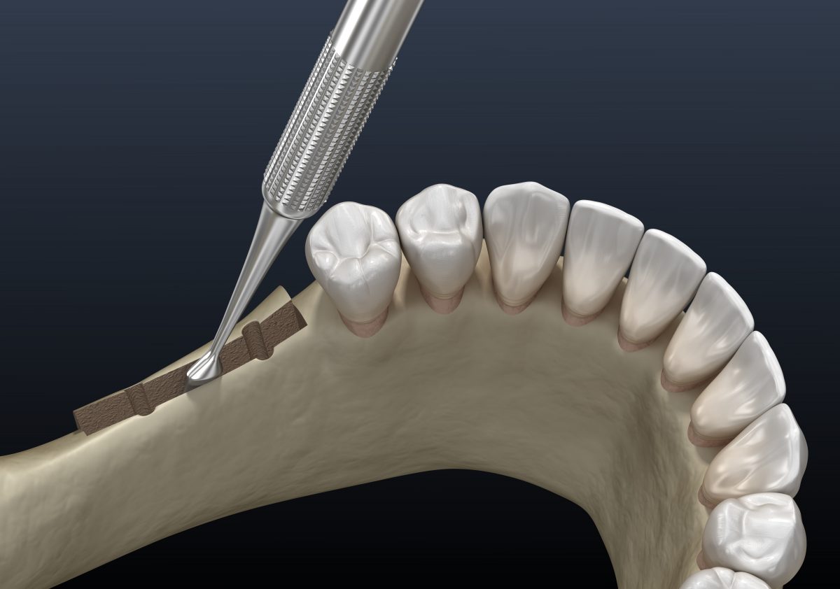 Making Smiles Implant-Ready With Grafting | Santa Rosa, CA