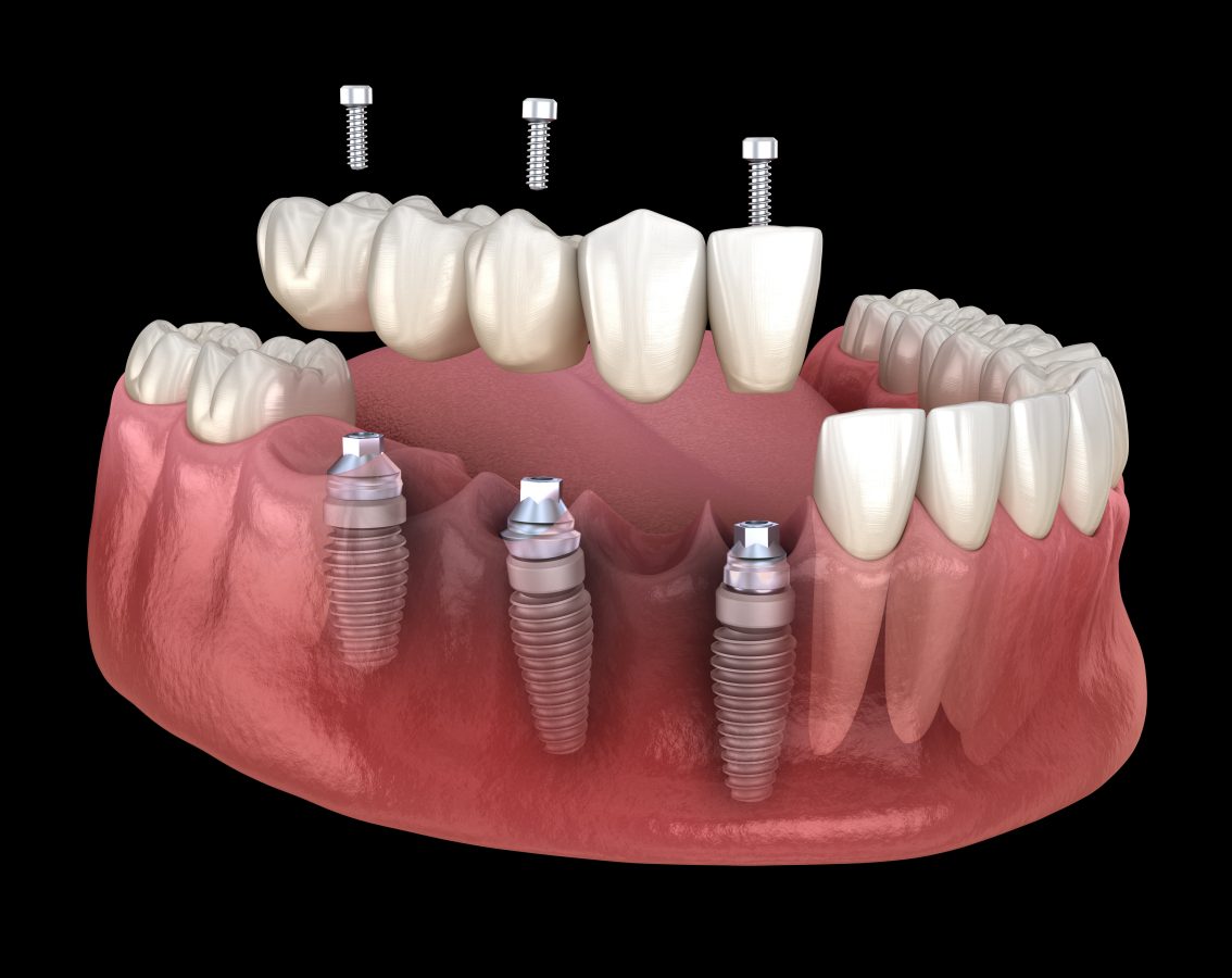 Preparing Smiles For Implants After Extraction | Santa Rosa, CA