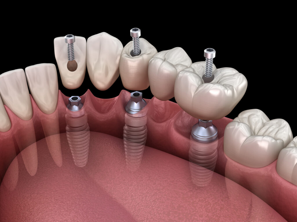 Supporting Dental Bridges With Implants Santa Rosa CA