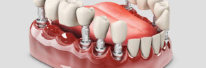 santa rosa implant partial denture