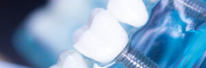 rohnert park tooth extraction