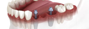 dental implant bridge rohnert park