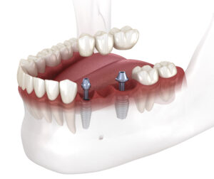 dental implant bridge rohnert park