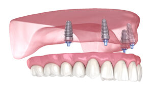 rohnert park grafting and implants