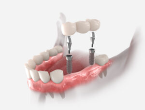 santa rosa implants and crowns