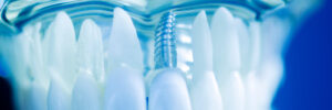 rohnert park dental implants