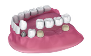 rohnert park dental implants