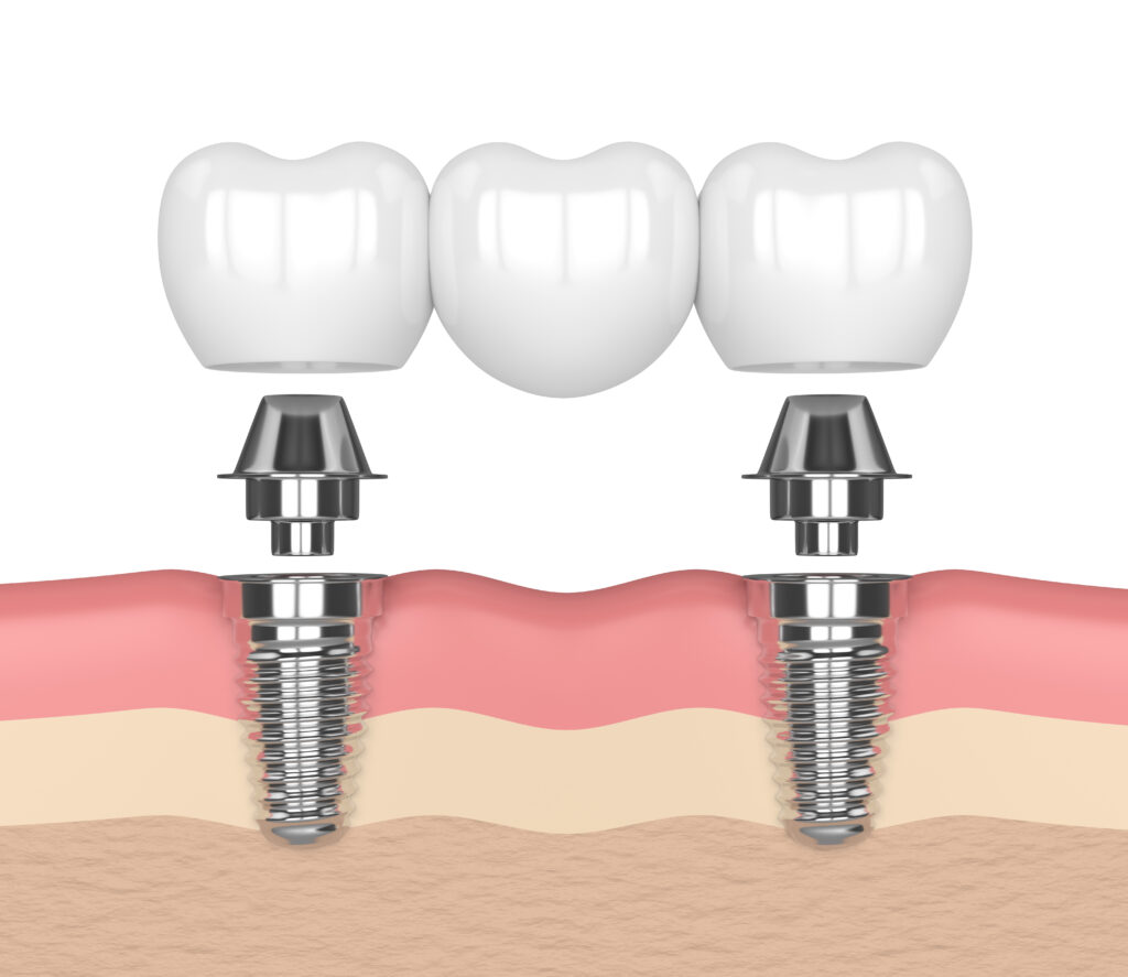 When Dental Implants Support Bridges Santa Rosa, CA
