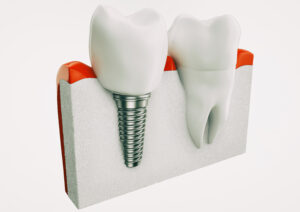 santa rosa dental implants