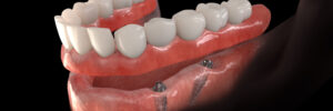 santa rosa implant dentures