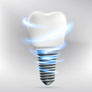 santa rosa placing dental implants