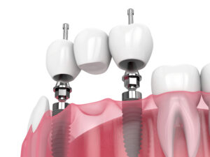 rohnert park implant bridges