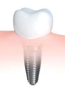 rohnert park dental implants