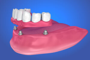 rohnert park implant dentures