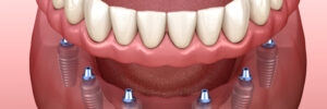 santa rosa implant dentures