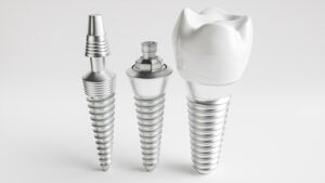 santa rosa dental implant and crown