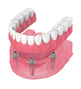 santa rosa implant dentures