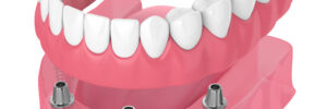 santa rosa implant dentures