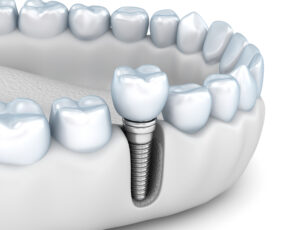 santa rosa implant technology