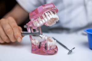 santa rosa dental implant