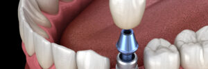 santa rosa implants and crowns