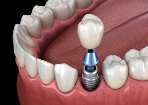 santa rosa implants and crowns