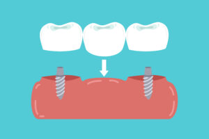 santa rosa implant bridges