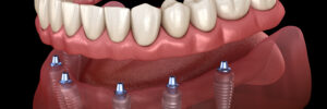 santa rosa implant dentures