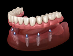 santa rosa implant dentures